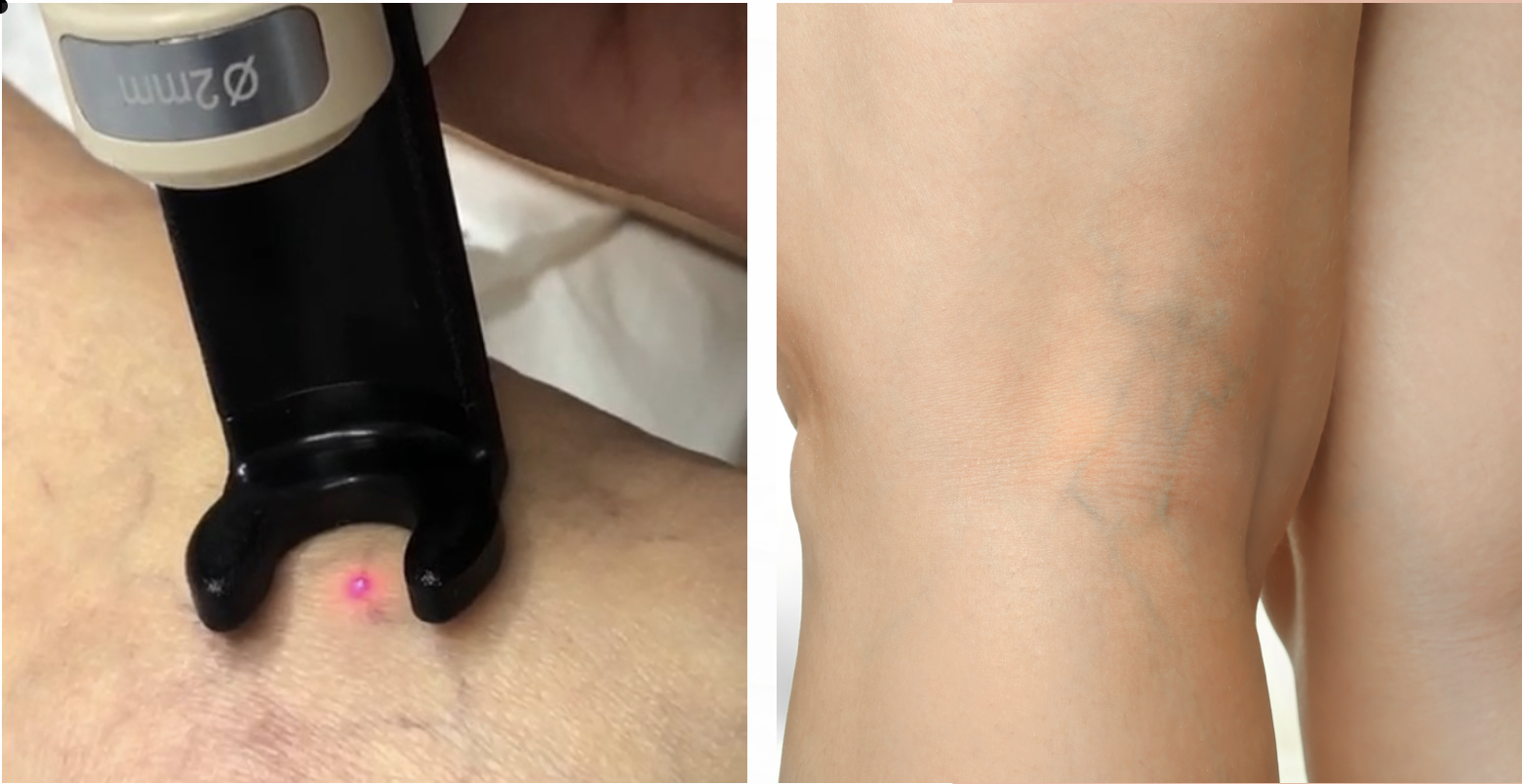 La tecnologia sicura ed efficace per il trattamento di capillari e lesioni vascolari