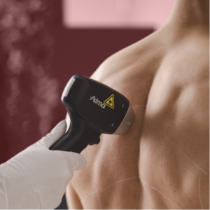 ALMA LASERS EPILAZIONE TOTAL BODY 6 SEDUTE